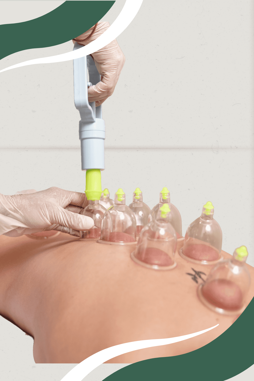 Cupping 2