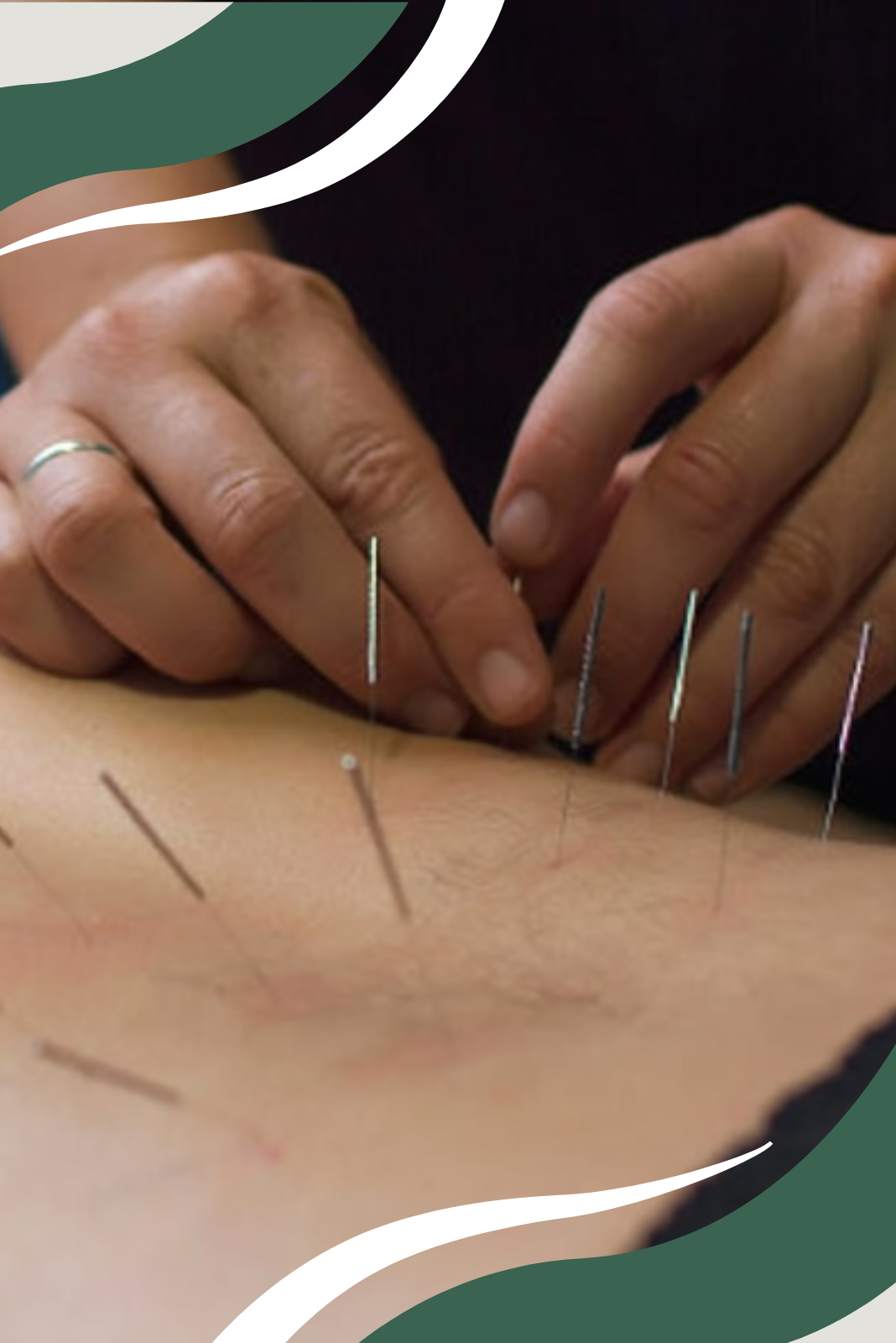 Needling 2